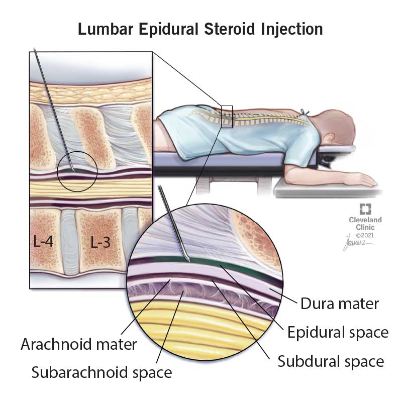 lumbar-spine-epidural-injection