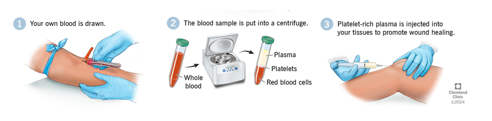 platelet-rich-plasma-prp-injection-horz